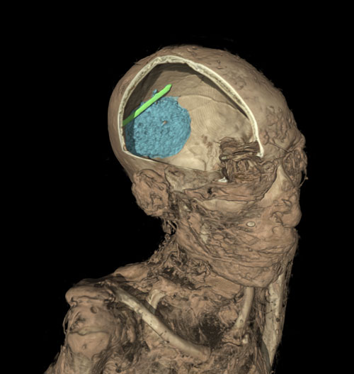 The CT scan of the skull of the mummy of an adult man (name unknown). The scan shows the remains of the brain (coloured in blue) and evidence of a tool that was left in the skull as a mistake during the mummification process (in green).